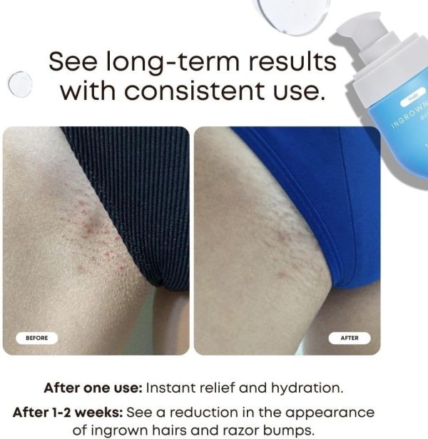 Bushbalm Ingrown Hair Oil - Helps with Ingrown Hair, Underar... - Image 2