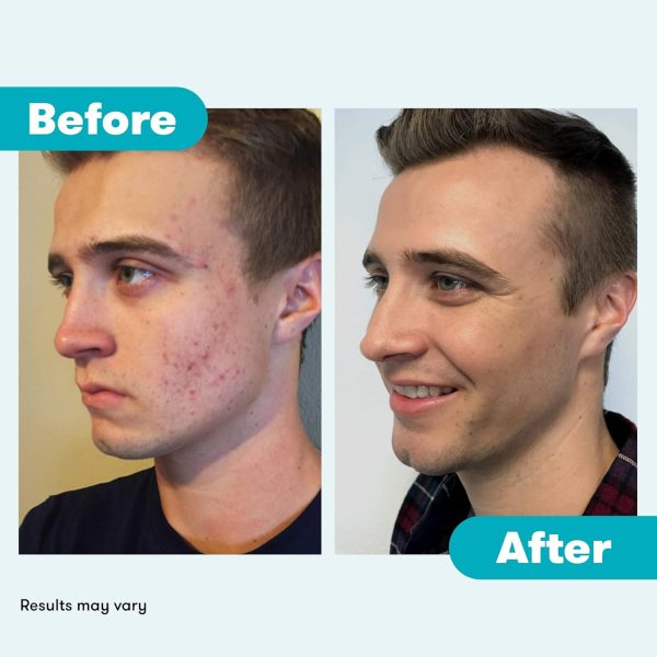 Proactiv 3 Step Acne Treatment - Benzoyl Peroxide Face Wash,... - Image 6